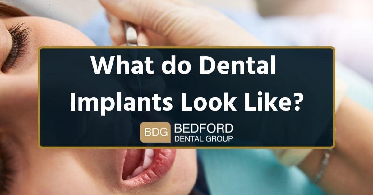 what do dental implants look like?