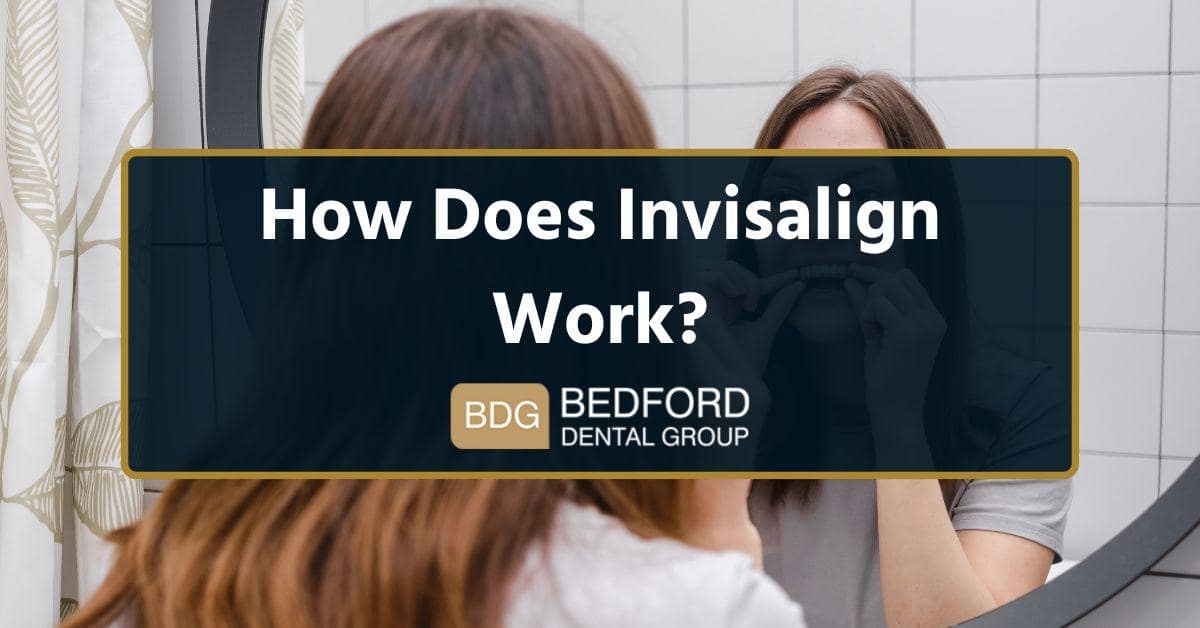 How Does Invisalign Work?