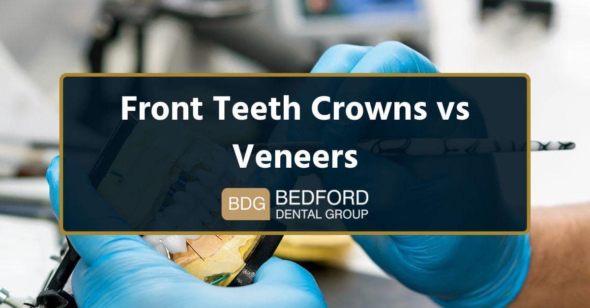 Front teeth crowns vs Veneers