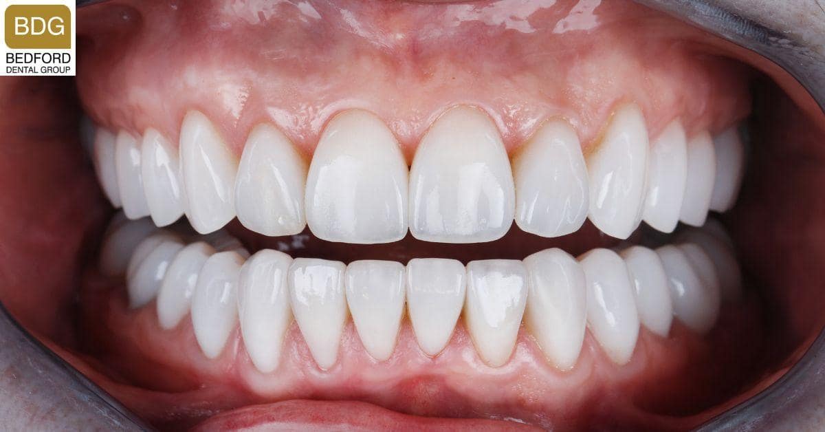 Comparison with a Natural Tooth Enamel
