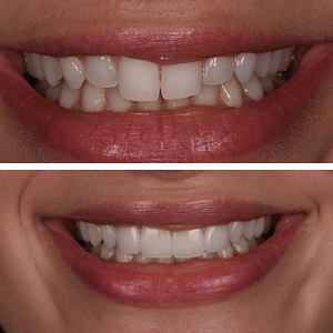 adrianna-before-and-after-veneers