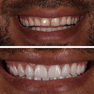 alejandro-before-and-after-veneers