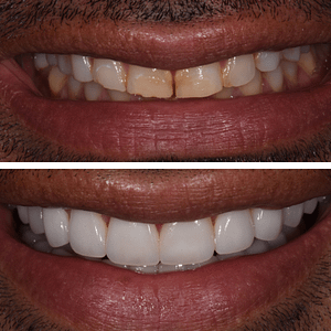 ali-r-before-and-after-veneers