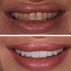 bianca-before-and-after-veneers