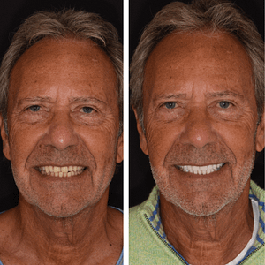 daniel-before-and-after-veneers (1)