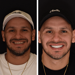 sebastian-before-and-after-veneers