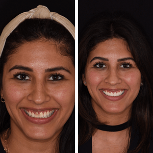 vri-before-and-after-veneers