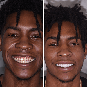 wesley-before-and-after-veneers
