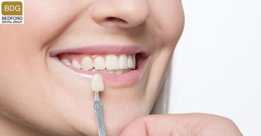 Are-Veneers-Permanent-beverly-hills