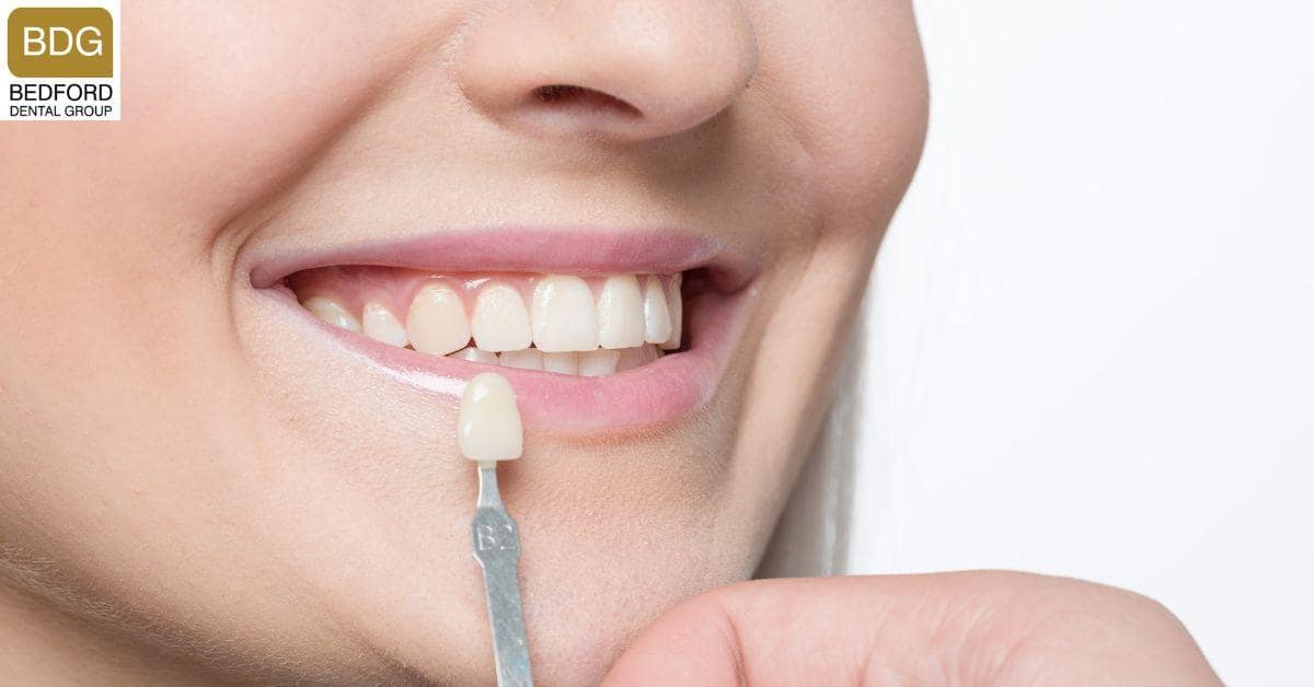 Are Veneers Permanent
