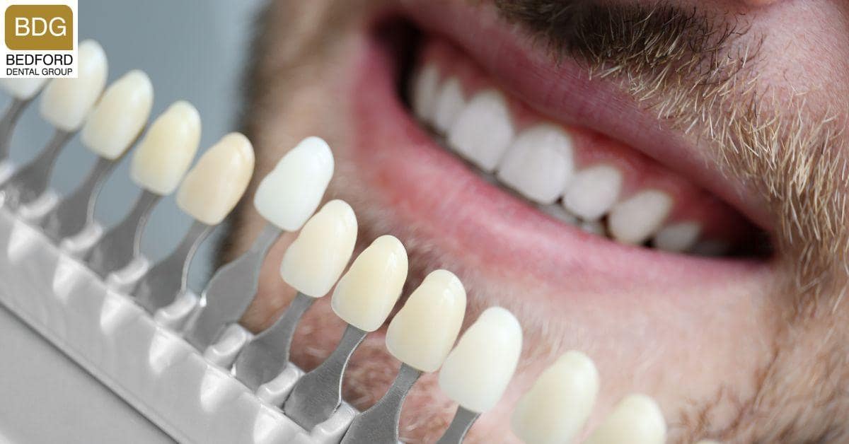 Dental Veneers