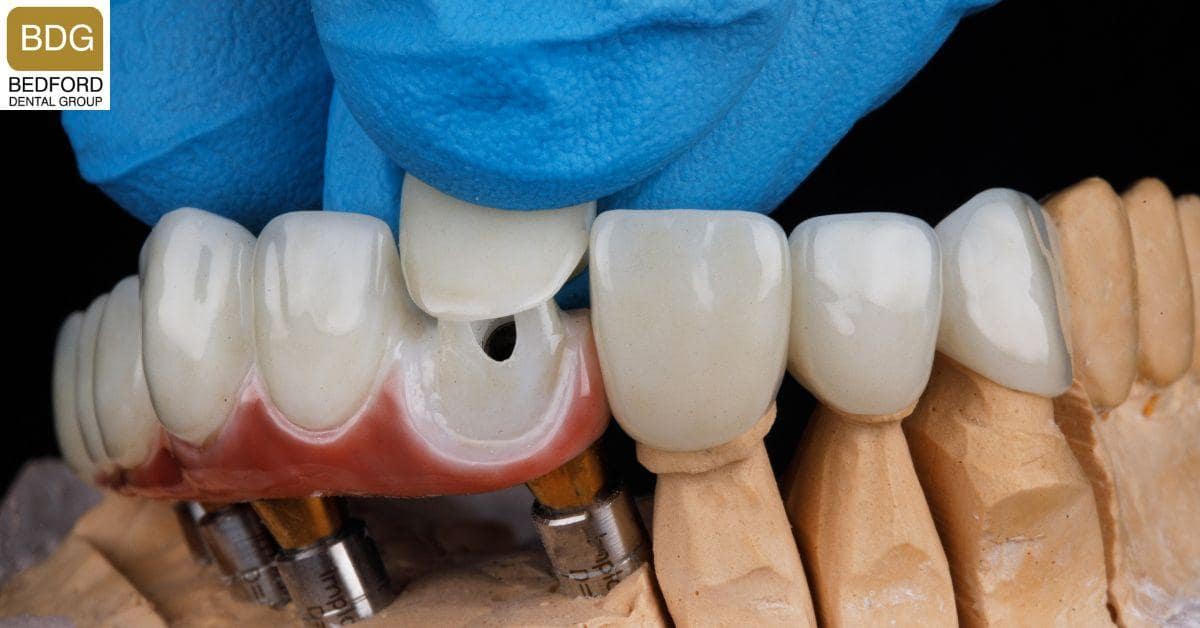 Is the Veneer Installation Always Successful