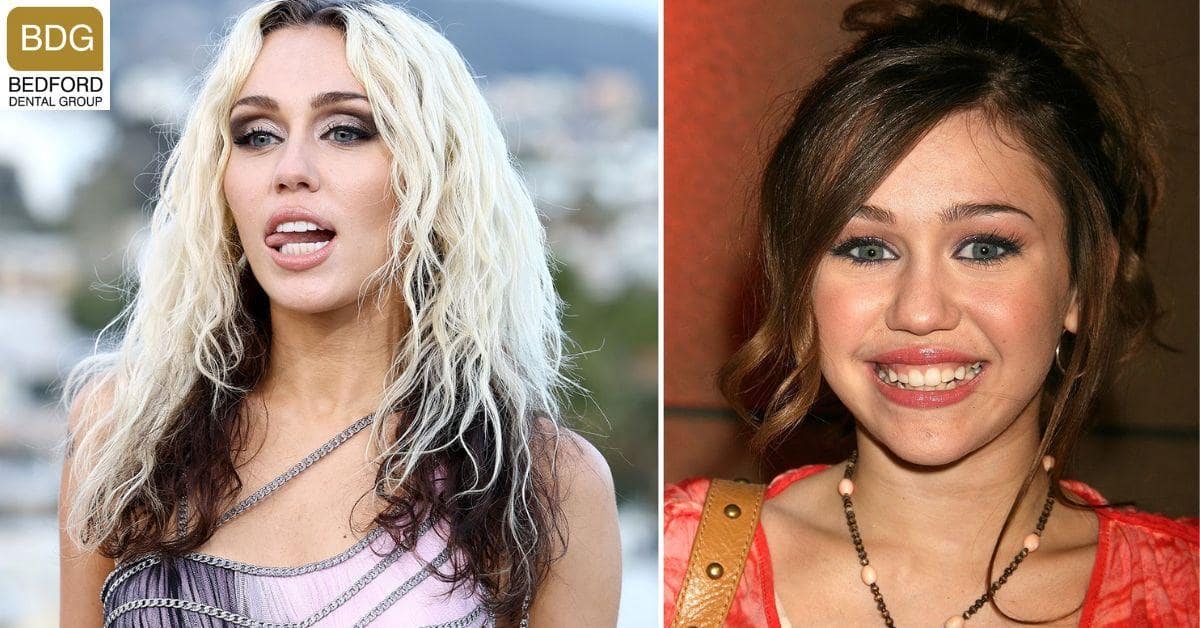 Miley Cyrus Veneers and Her Smile Transformation