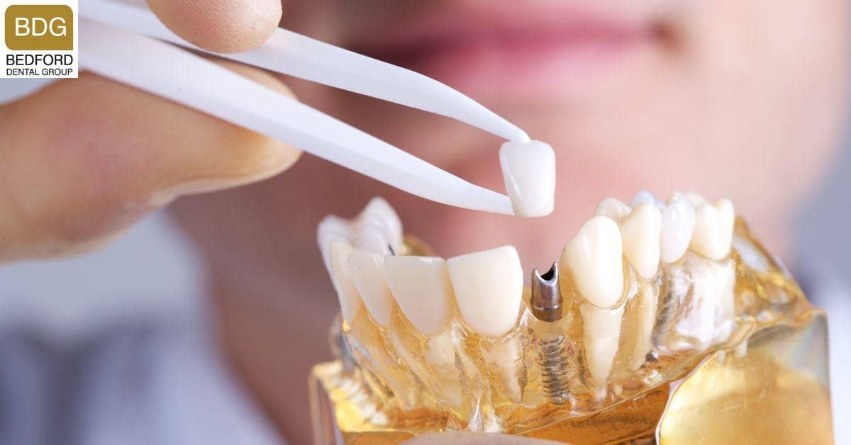 Other Alternatives to Veneers - dental implants