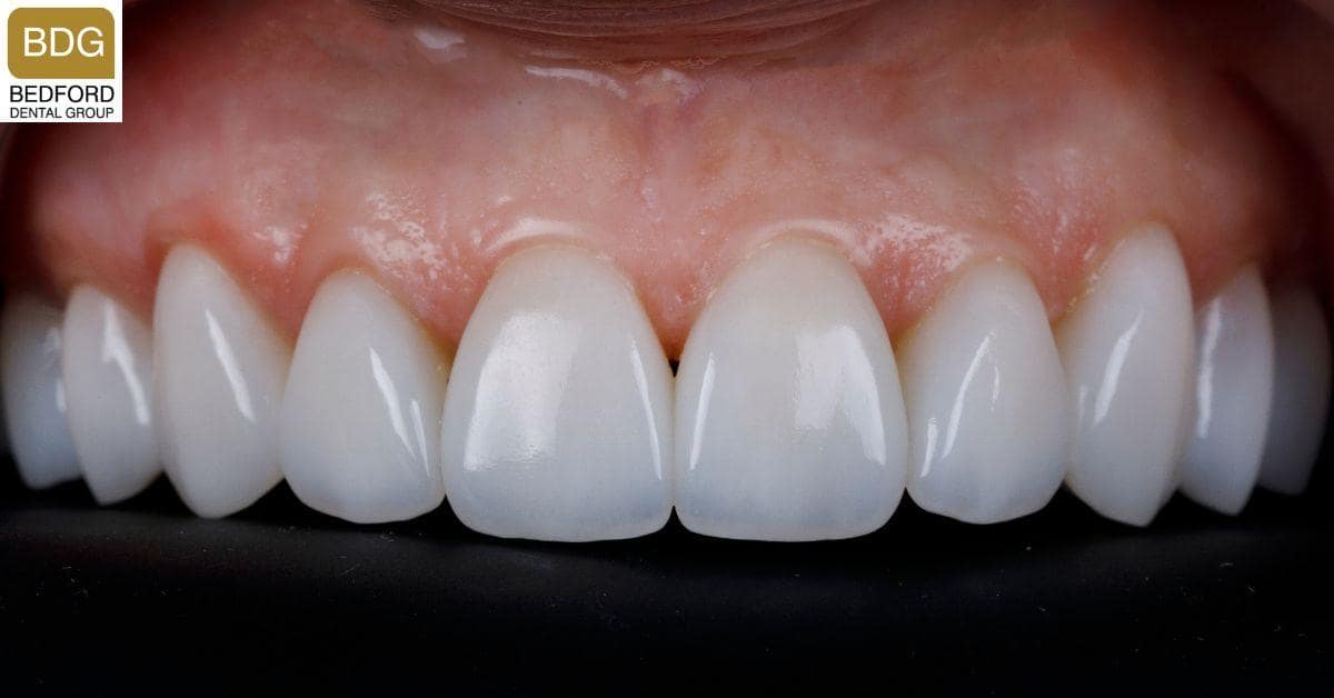 The Process of Getting Porcelain Veneers