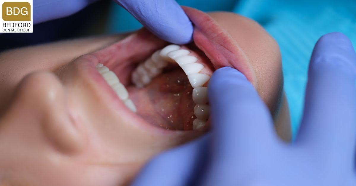 What Are Composite Veneers?