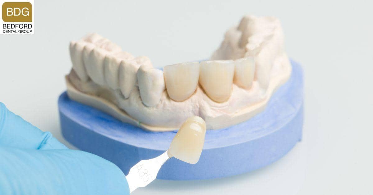 What Are Dental Veneers?