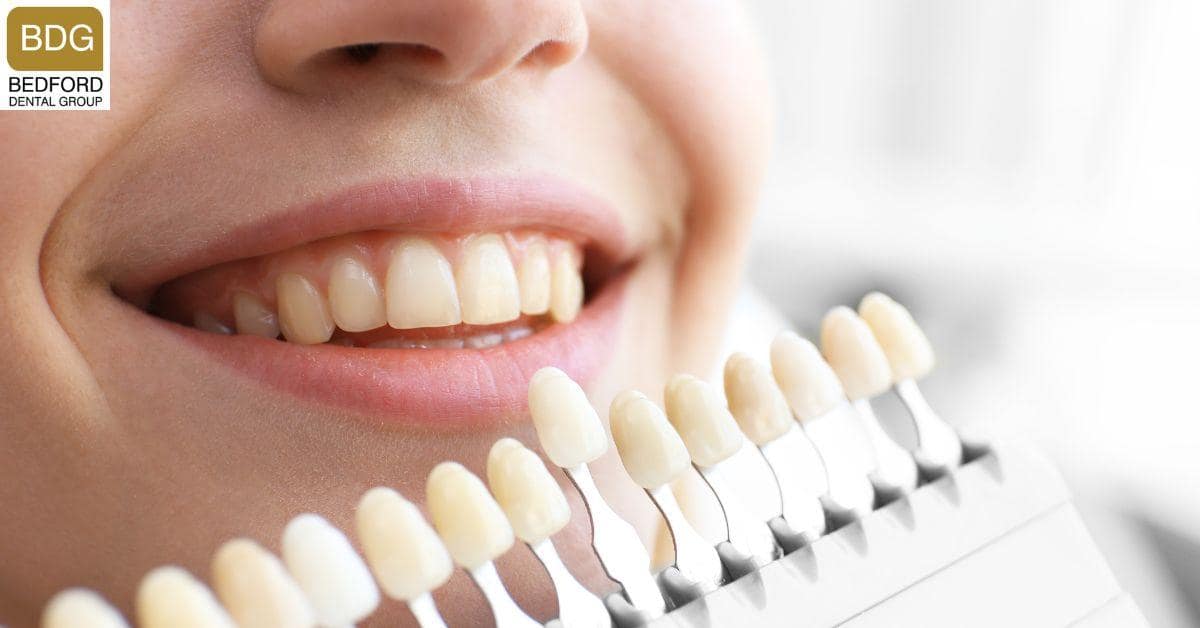 What Are Porcelain Veneers?