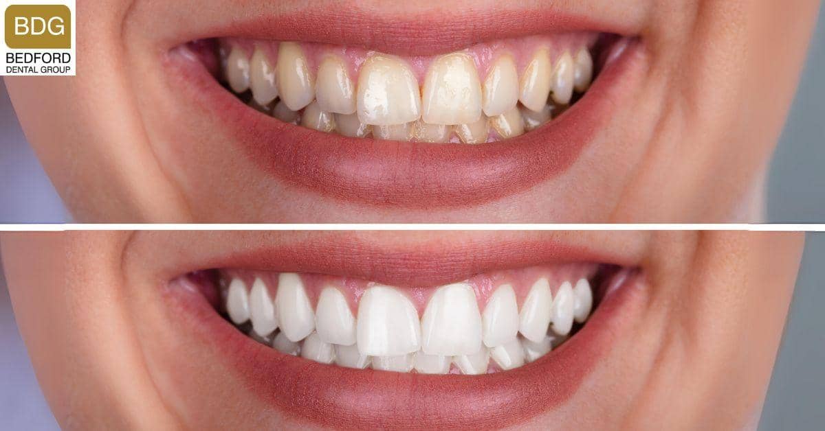 What Can Cause Veneers to Discolor?