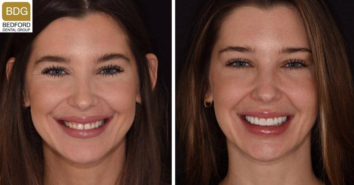 Who Should Get Veneers?