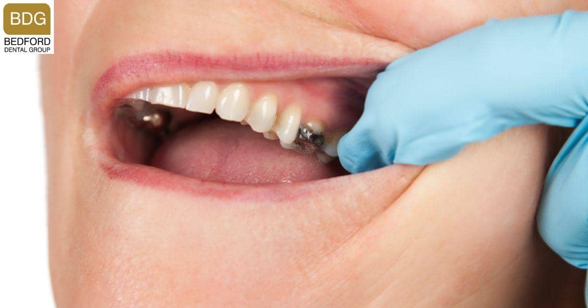 More on Tooth Decay
